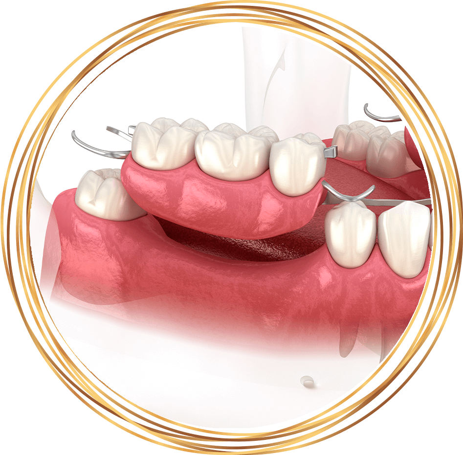 partial denture 3d rendering