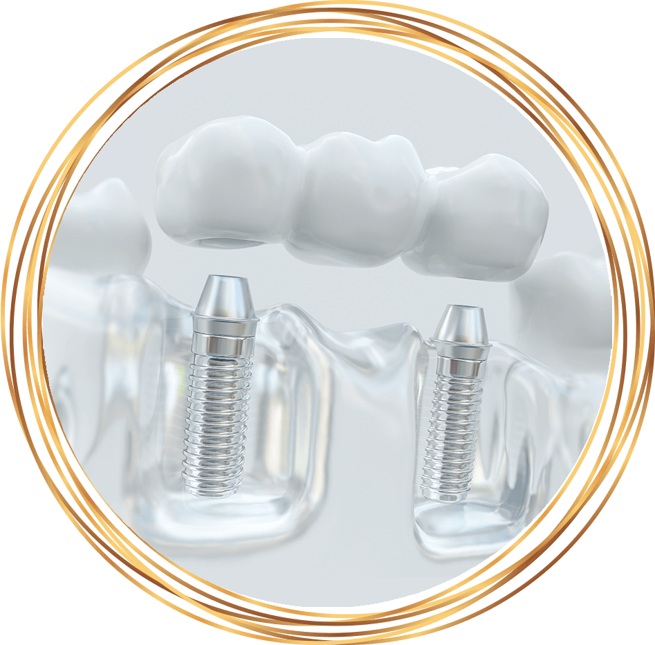dental implant bridge