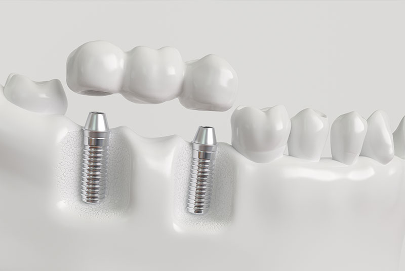dental implant bridge