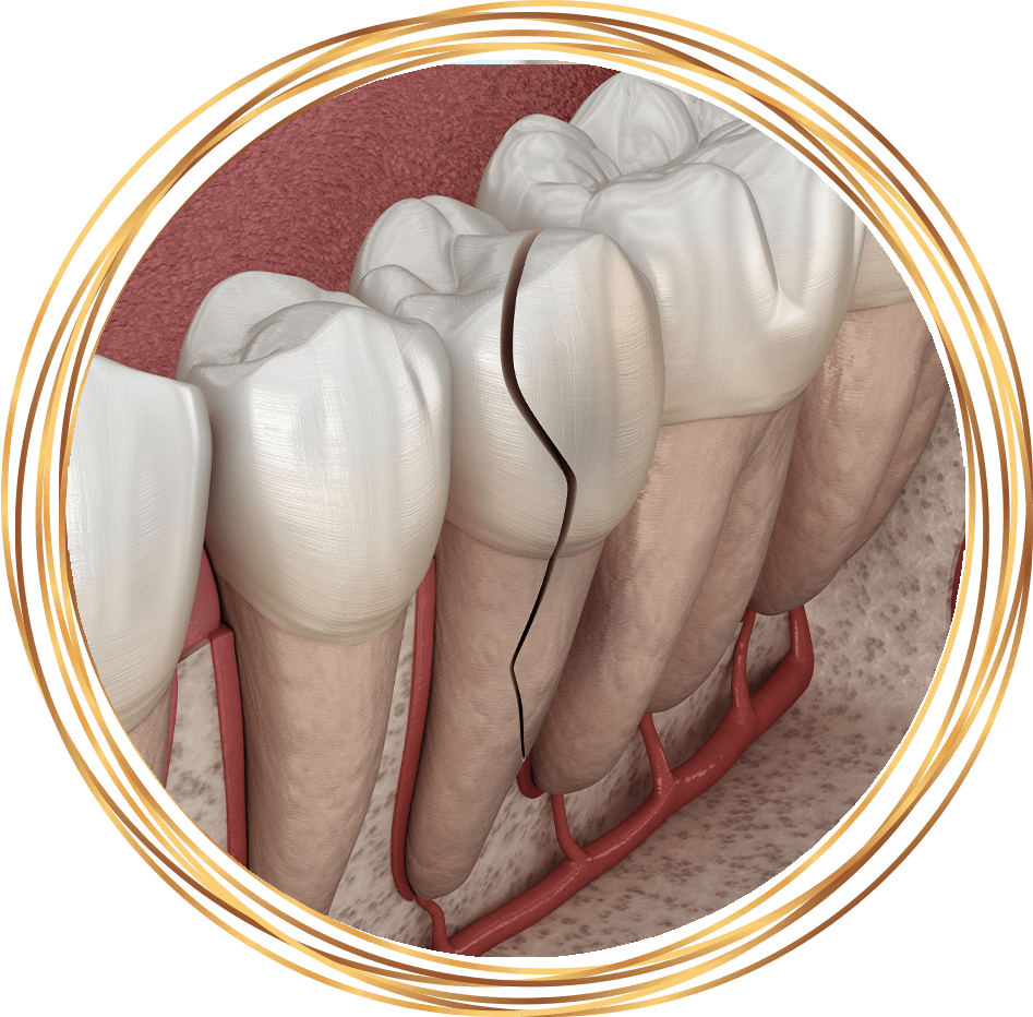 cracked tooth 3d rendering