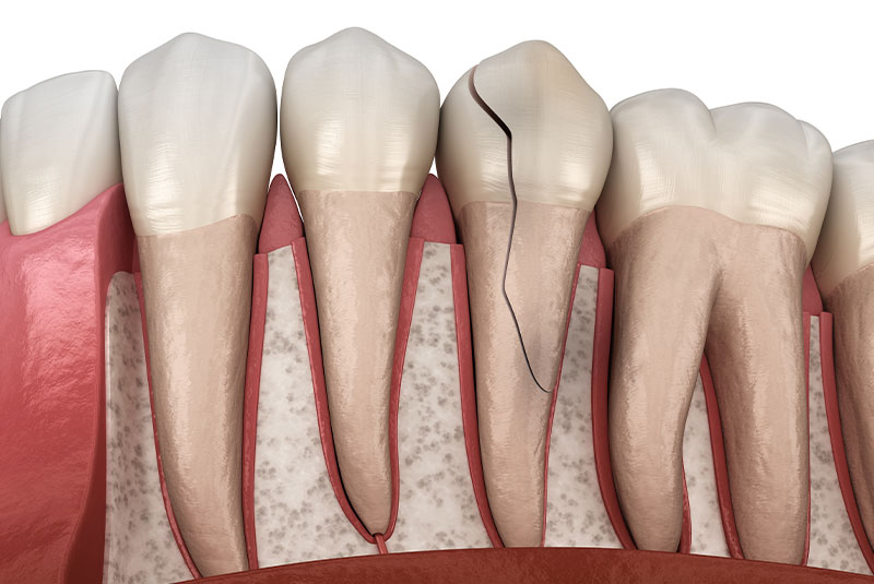 cracked tooth - symptom of root canal