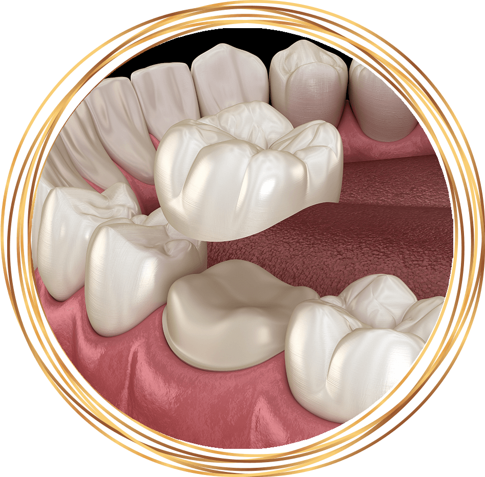 dental crown