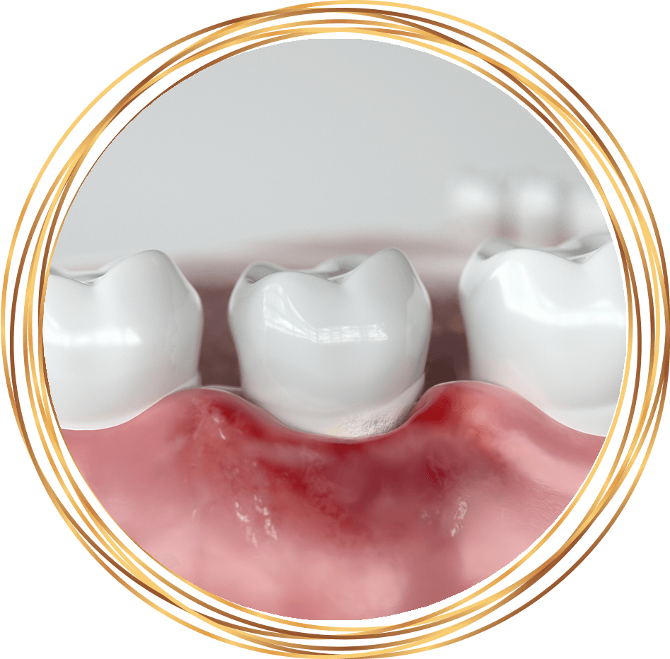 inflamed and red gums
