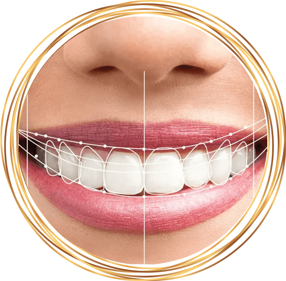 dental patient smiling with lines on teeth indicating measurements