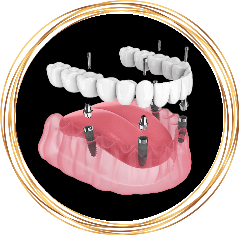 all on 4 fixed dental implants