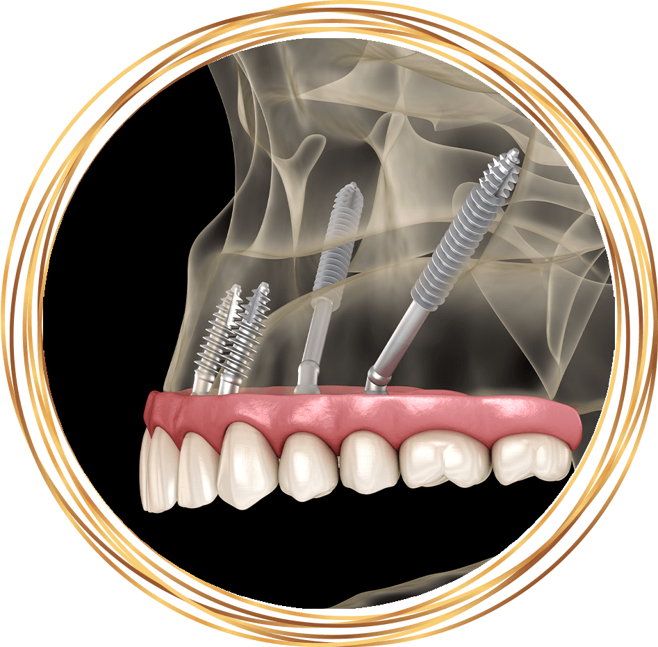 zygomatic dental implants 3d rendering