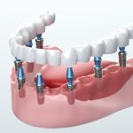 Dental Implants in Redding