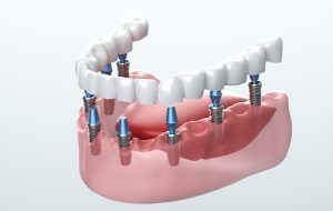 Dental Implants in Redding