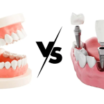 Dentures or Implants
